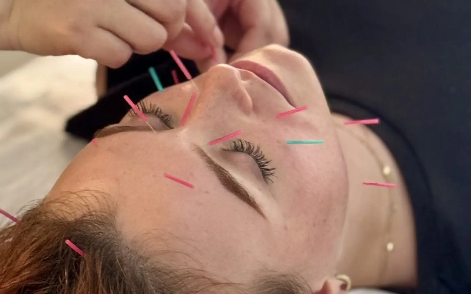 Facial acupuncture with very fine needles during a TCM session in Shanghai