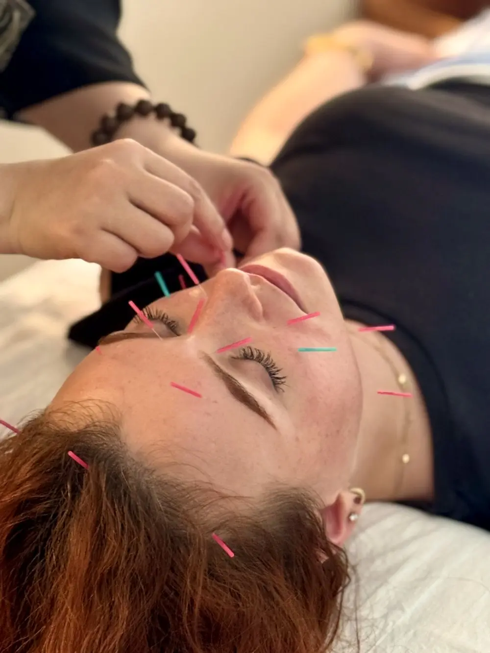 Facial acupuncture with fine needles during a TCM session in Shanghai