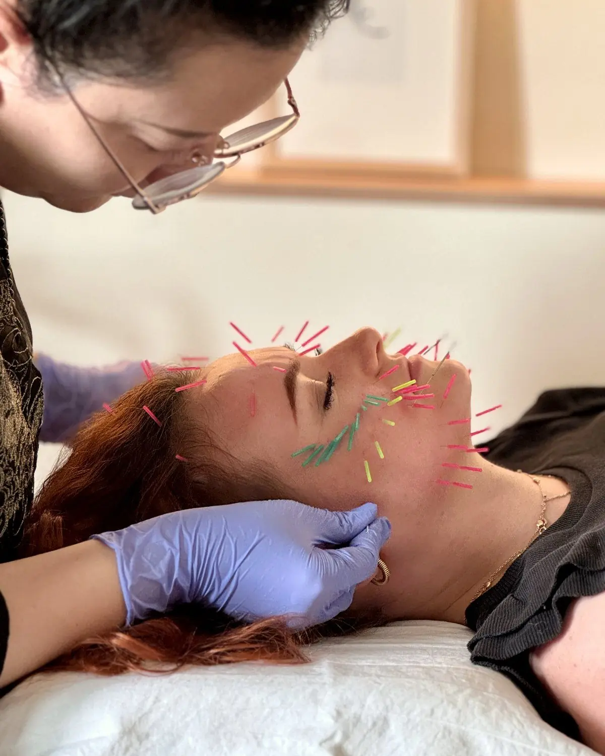 Facial acupuncture with fine needles during a TCM session in Shanghai